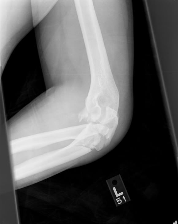 broken elbow treatment